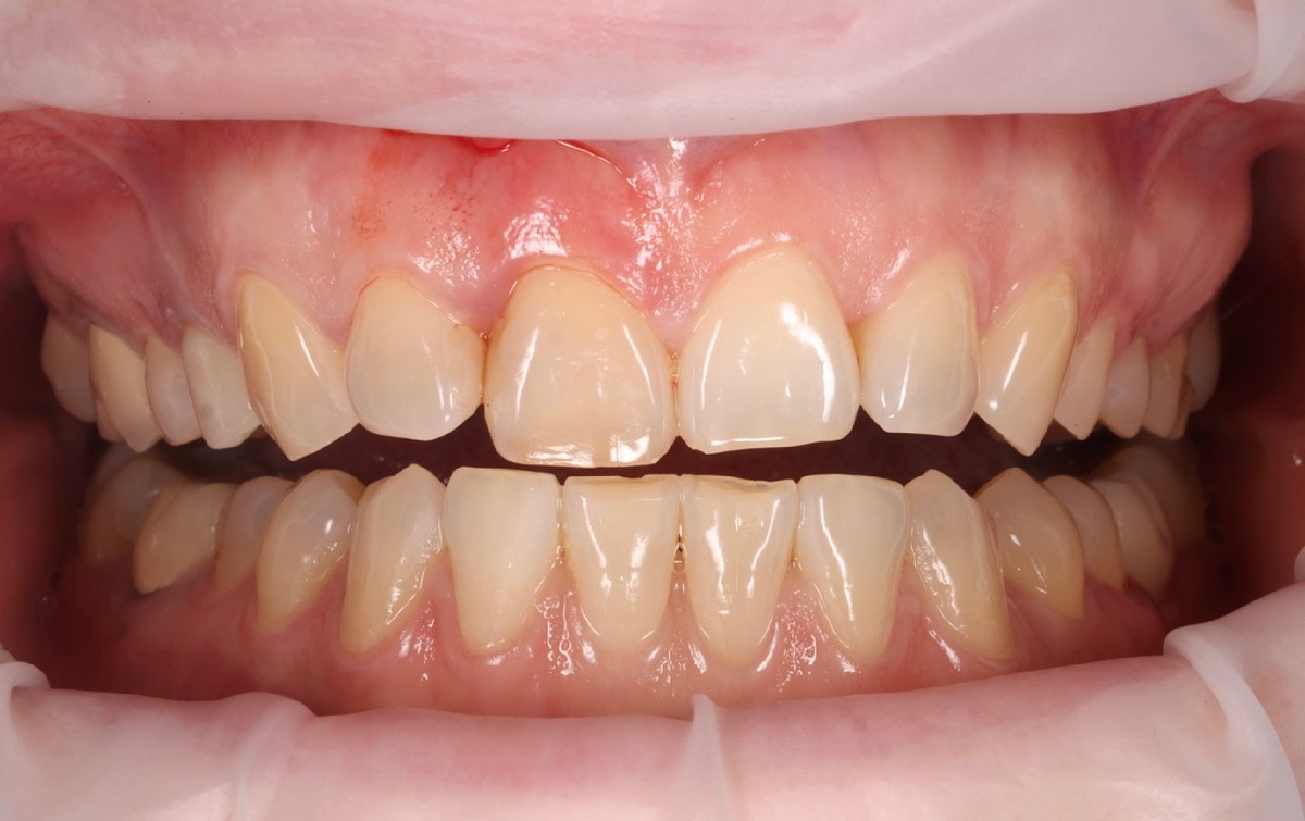 Зуб 1.1 - перелом коронковой части