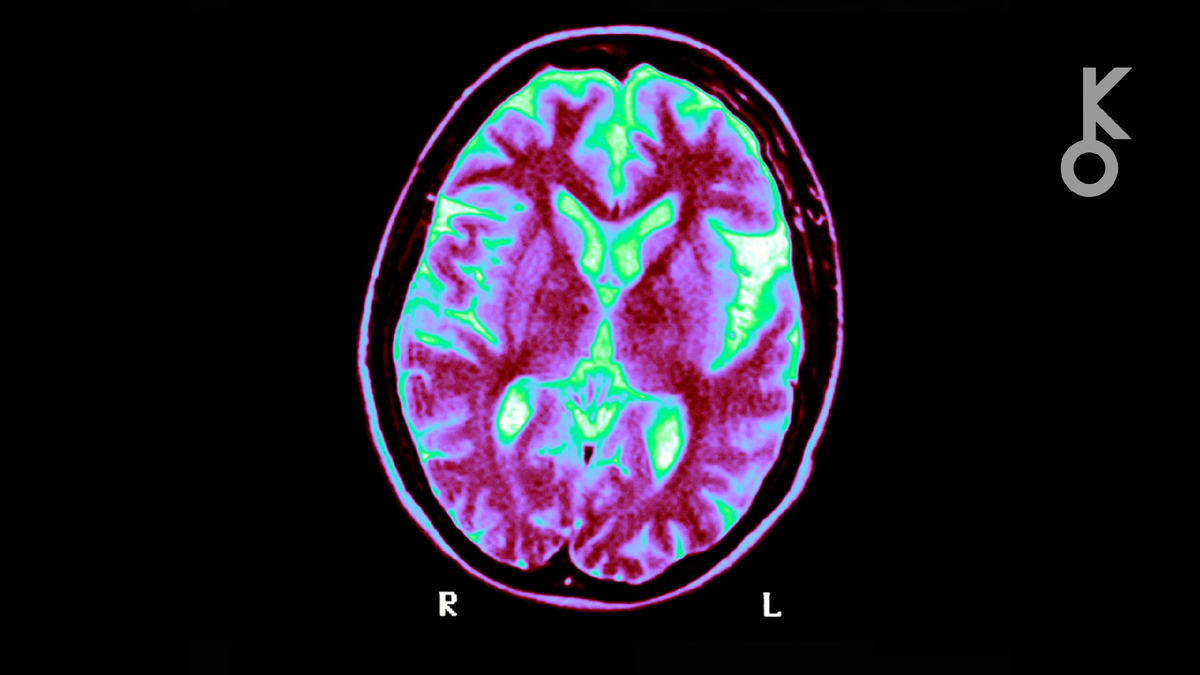 Ученые выяснили, что нейроны перерабатывают сахар иначе, чем считалось. Это открытие может стать ключом к лечению болезней Альцгеймера и Паркинсона.