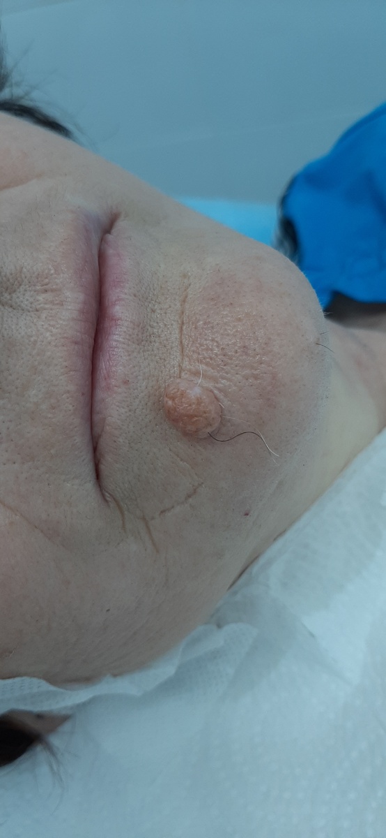 На представленном фото состояние перед операцией. Новообразование расположено в подбородочной области справа, на нём имеется несколько волос.