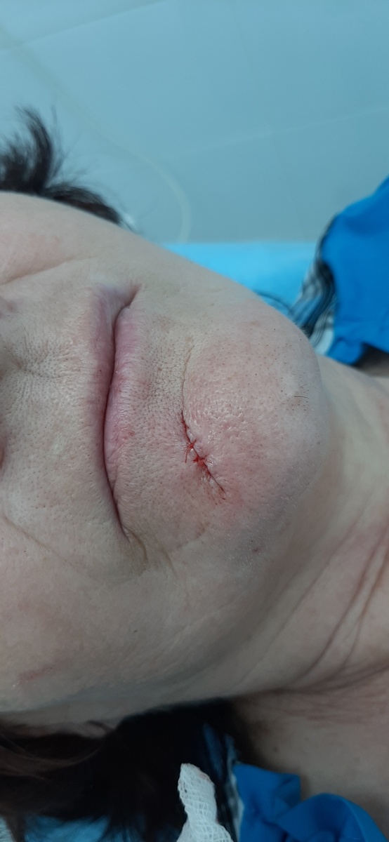 На фото после операции видна линия шва и две нити с узлами.