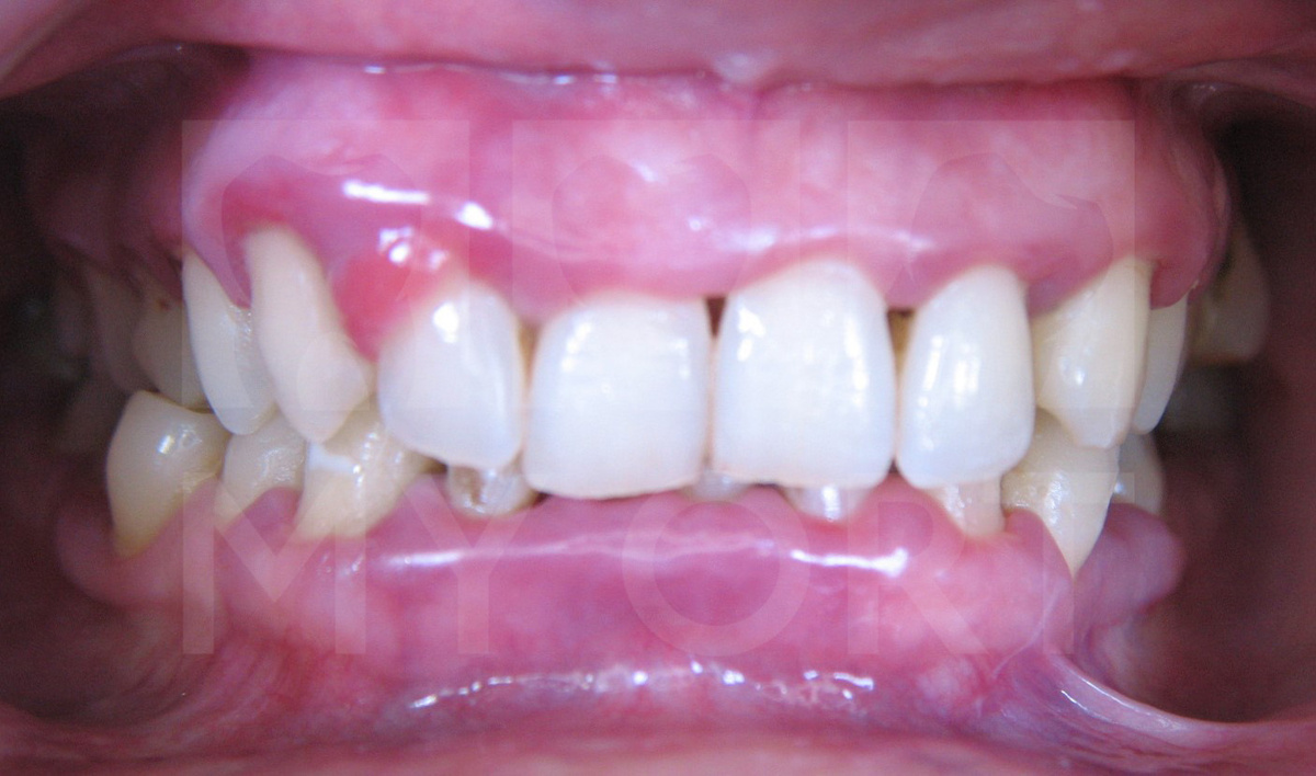 До начала лечения