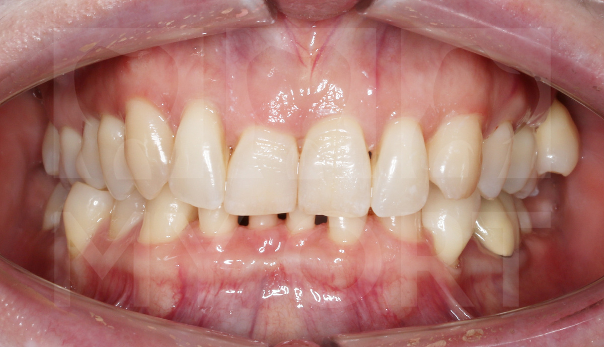 Через 10 лет после начала лечения