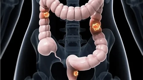 Рак кишечника - как распознать, первые признаки, диагностика