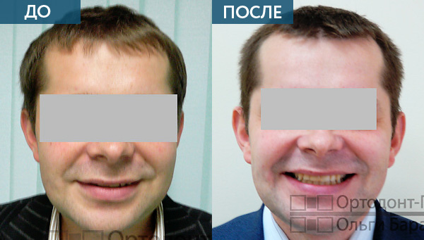 Ортодонтическое лечение брекетами INCOGNITO