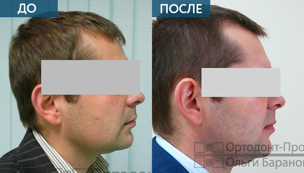 Jртодонтическое лечение неправильного прикуса брекетами INCOGNITO