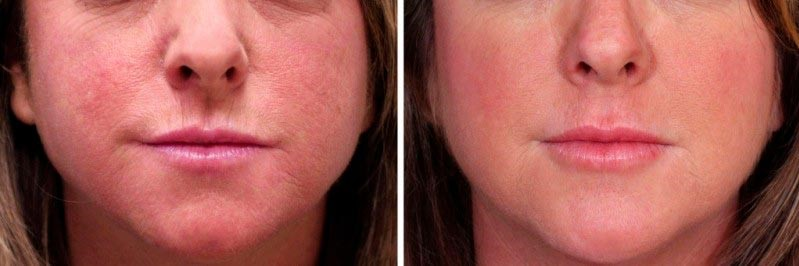 Результат криомассажа