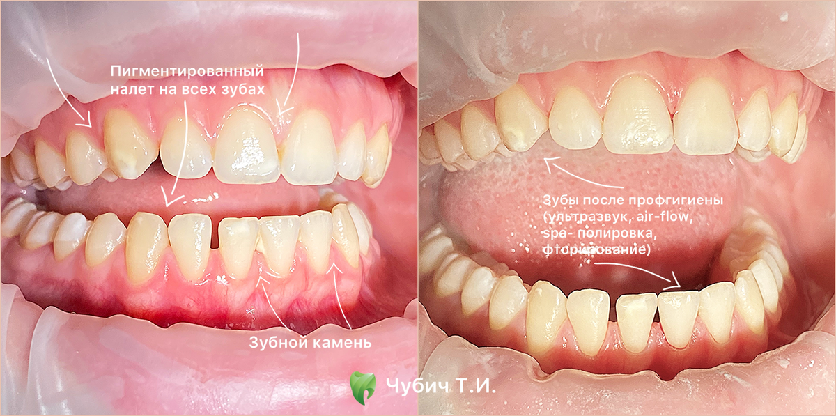 Профгигиена у подростка "четвре в одном" (ультразвук, air-flow, spa- полировка, фторирование)