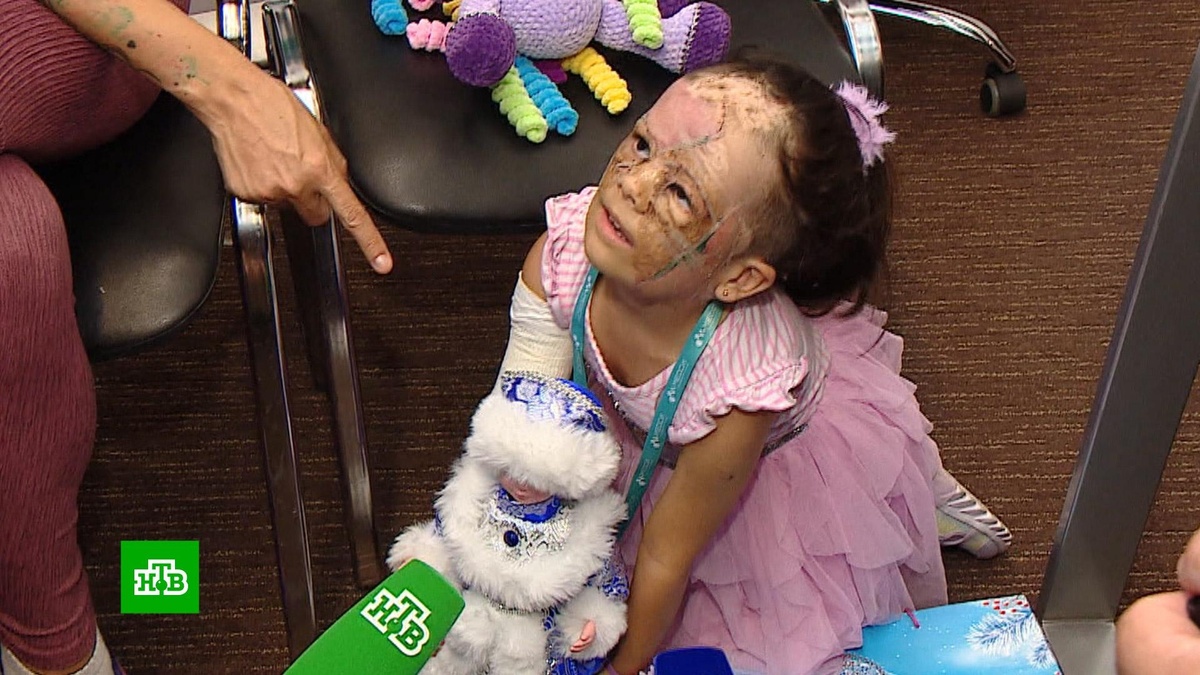    Врачи в Петербурге удалили большое родимое пятно девочке с «маской Бэтмена»