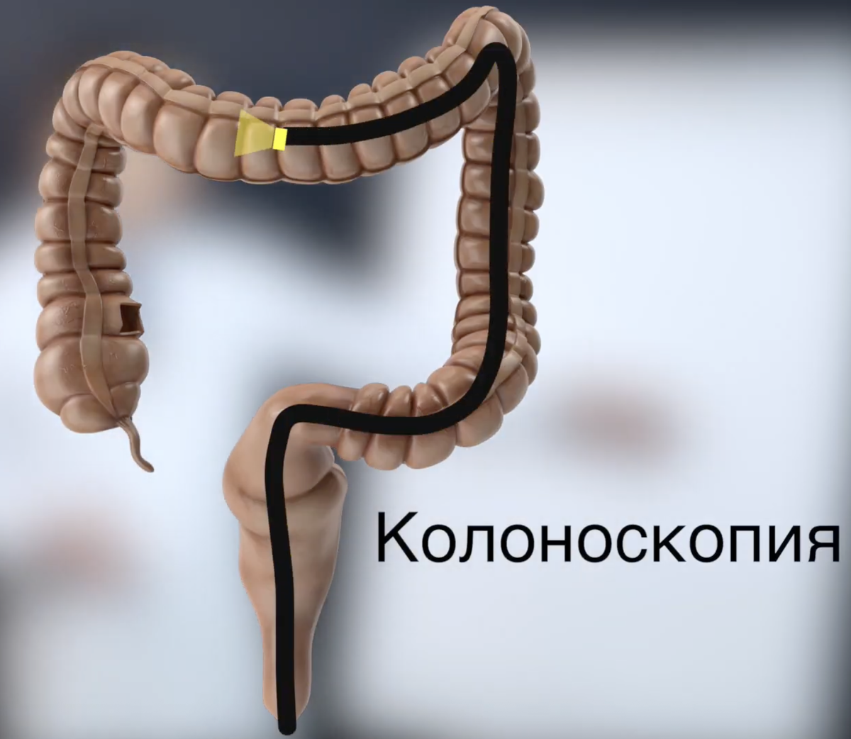 Колоноскопия - ведущий метод диагностики рака толстой кишки! А еще с помощью этого прибора врачи удаляют полипы, избавляя пациента от риска заболеть раком!