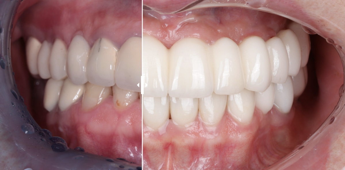 Зубы до и после. Стоматология "Дант"