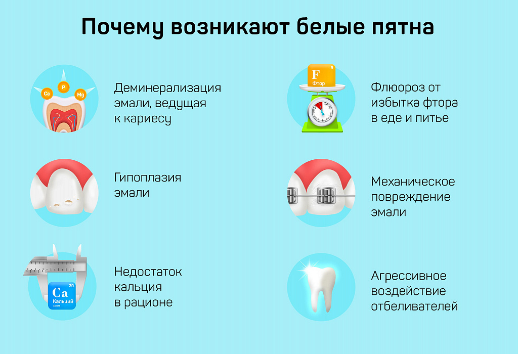 Я выделила шесть причин возникновения белых пятен на зубах: