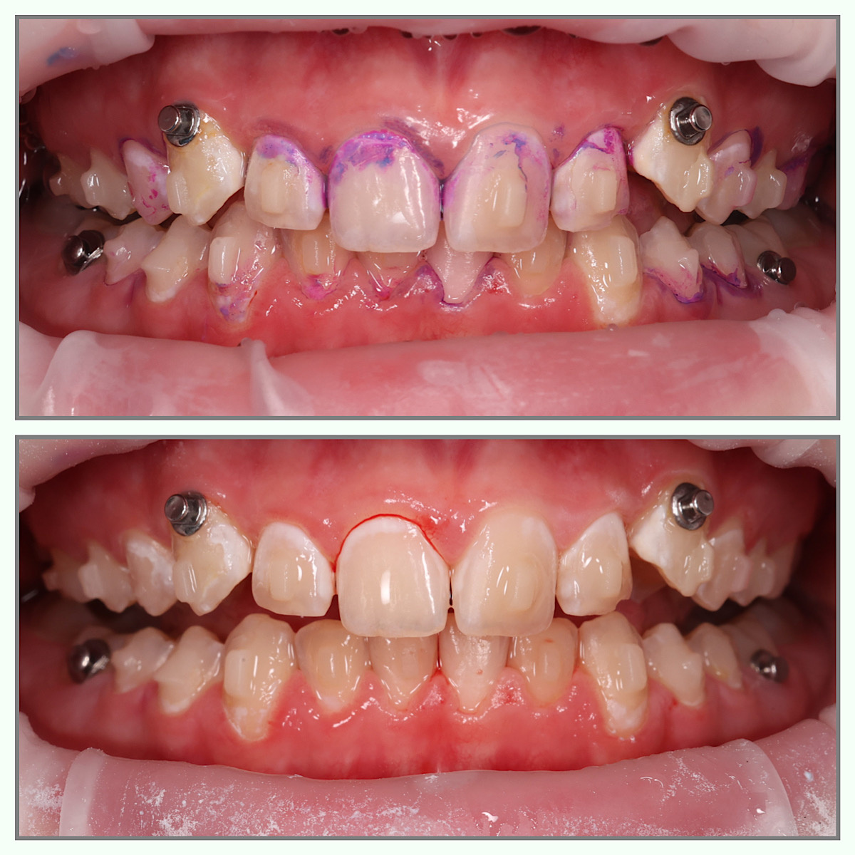 1 фото:окрашивание налета с помощью индикатора для наглядности, фиолетово-розовые участки-это налет, 2-фото после проведения проф.гигиены, белые участки на зубах-это очаги деминерализации 