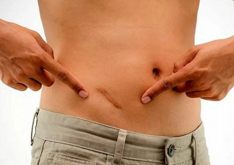 Аппендицит: почему он возникает и что ни в коем случае нельзя при подозрении на него