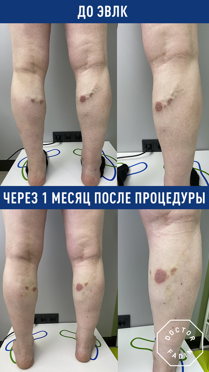 «Пиявки, соль и тромб в лёгкое»: врач-флеболог — о том, почему самолечение варикоза смертельно опасно 