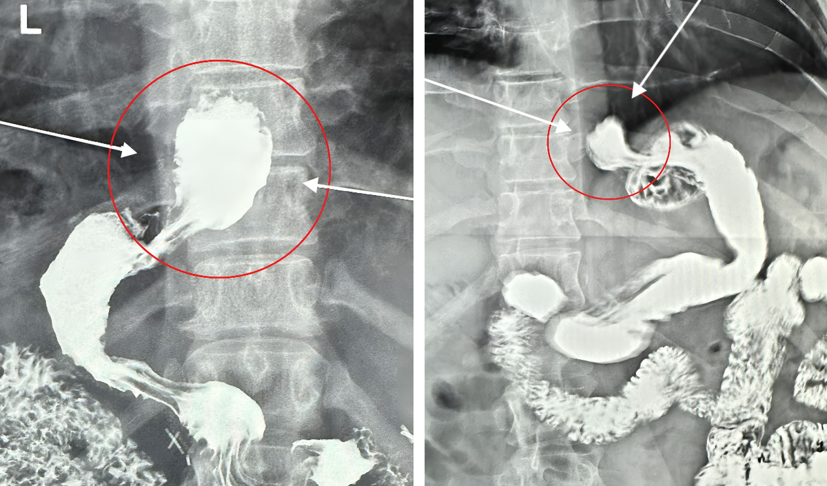 Рентгенограммы культи желудка после выполнения СЛИВ. Грыжа пищеводного отверстия диафрагмы (обозначена стрелками)