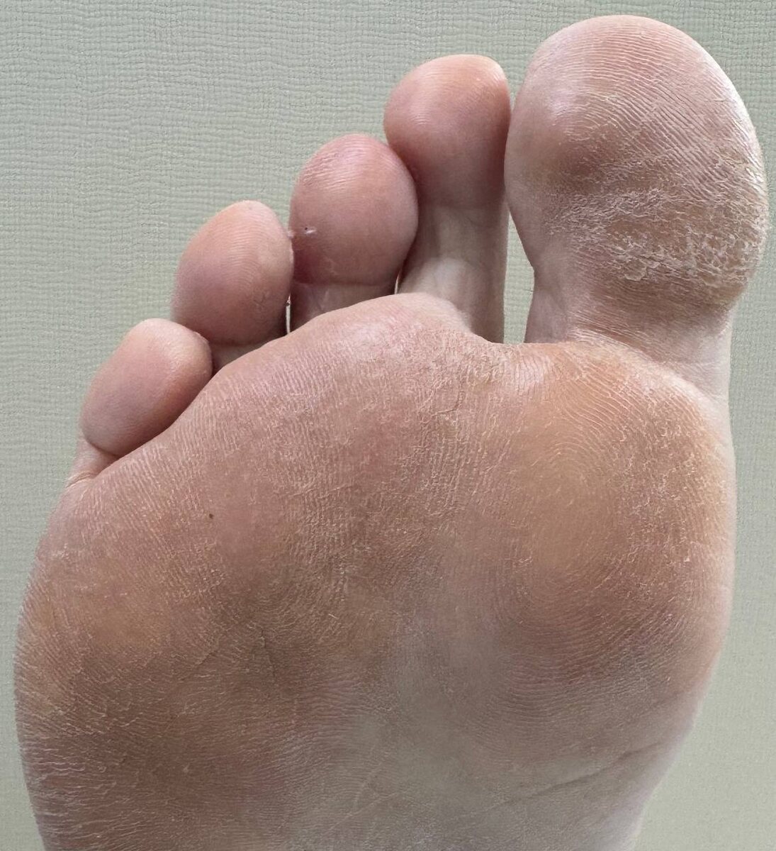 Стопы клиентки до подологической обработки