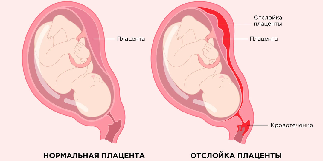 Преждевременная отслойка плаценты: почему она происхдит и чем она опасна