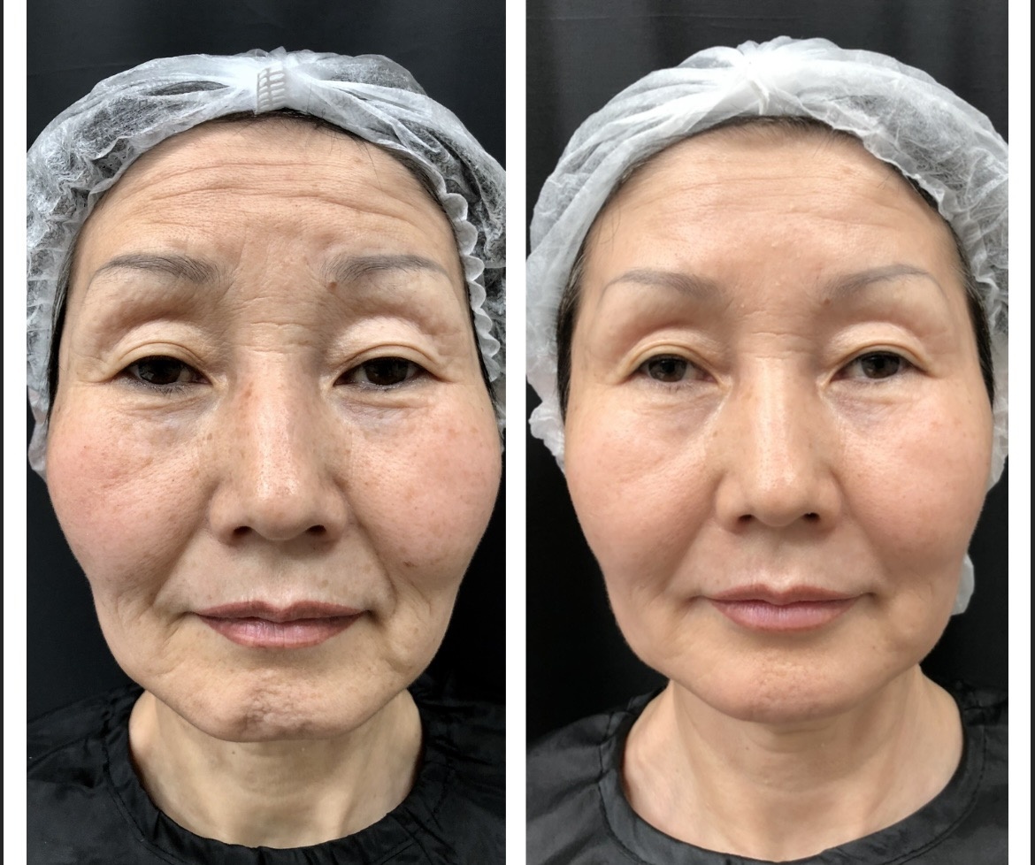 До и после проведенных процедур