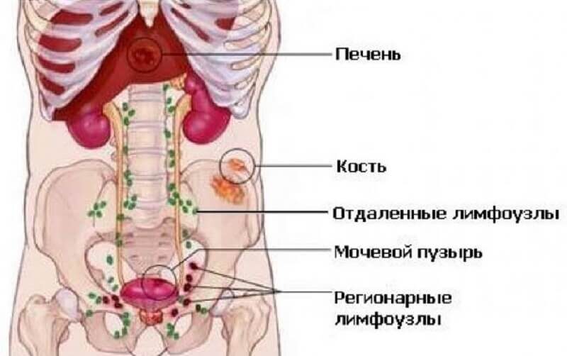 Метастазы в лимфоузлах – не приговор
