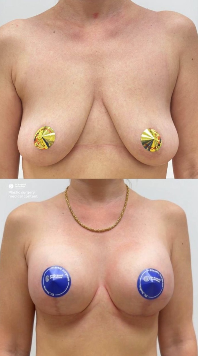 Подтянули и симметризировали грудь, установили импланты 325 мл 