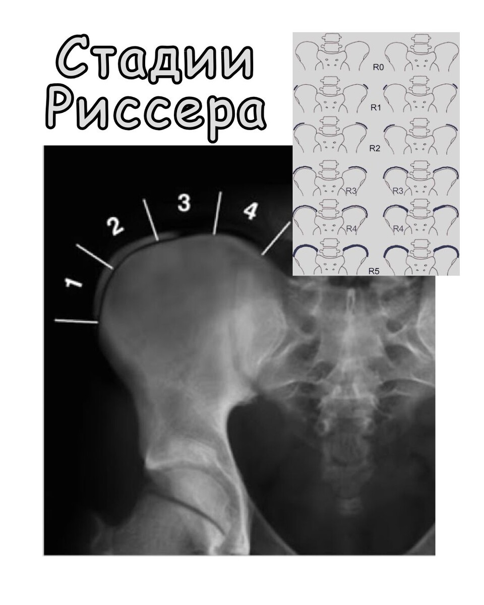Стадии (степени) Риссера