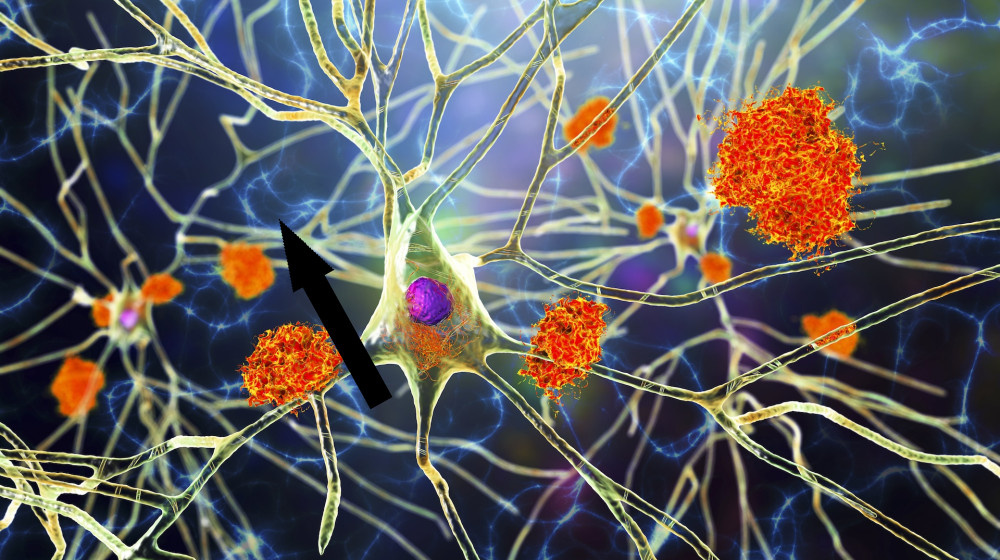    Новый тест на кровь для борьбы с Альцгеймером — что нужно знать уже сегодня