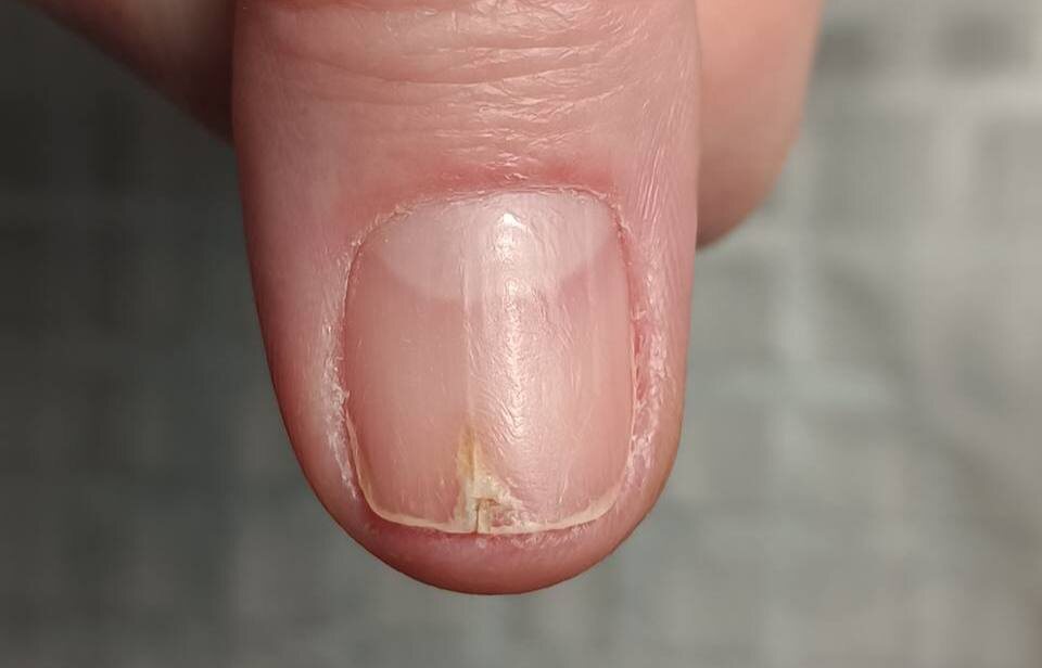 Онихорексис. Фото — Центр подологии PodoFocus