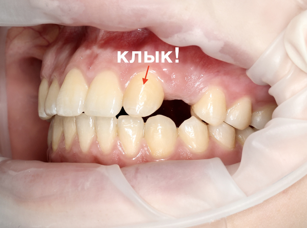 Клык на месте двойки