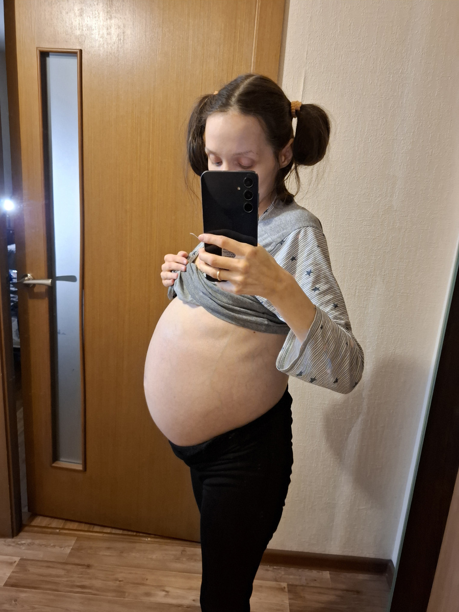 Напряженный асцит около 15 литров