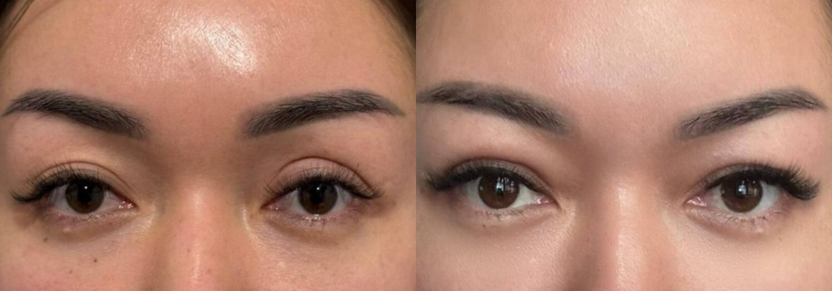 Переделка после неудачной блефаропластики, фото до и после. Фото с сайта Д.Р. Гришкяна. Имеются противопоказания, требуется консультация специалиста