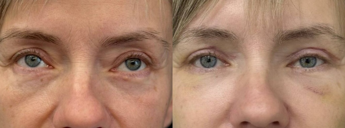 Провели повторную операцию: удалили грыжи, скорректировали лишнюю кожу, устранили деформацию, дополнили результат липофилингом средней зоны и нижних век. Фото до и после. Фото с сайта Д.Р. Гришкяна. Имеются противопоказания, требуется консультация специалиста