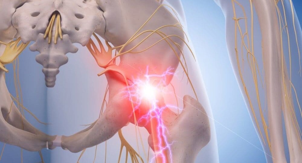 Физиотерапия при невропатии седалищного нерва: методы облегчения боли