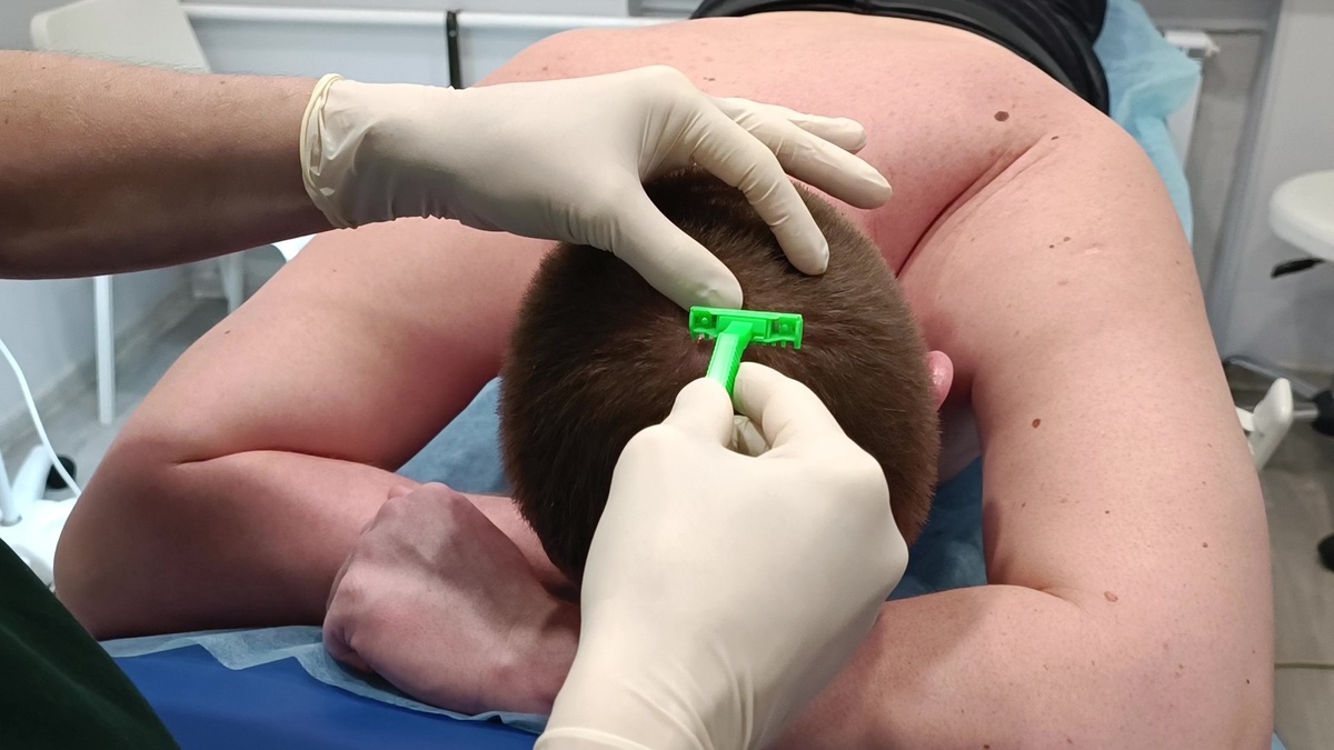 Экономное сбривание волос перед удалением атеромы на голове