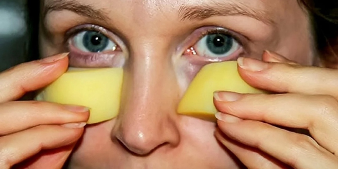 Почему отёки под глазами не всегда просто косметика