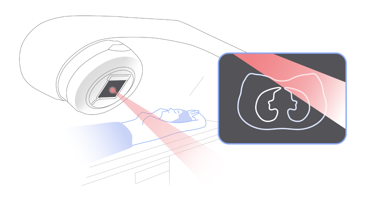 Дистанционная лучевая терапия. Источник иллюстрации: онлайн-энциклопедия «Онко Вики»