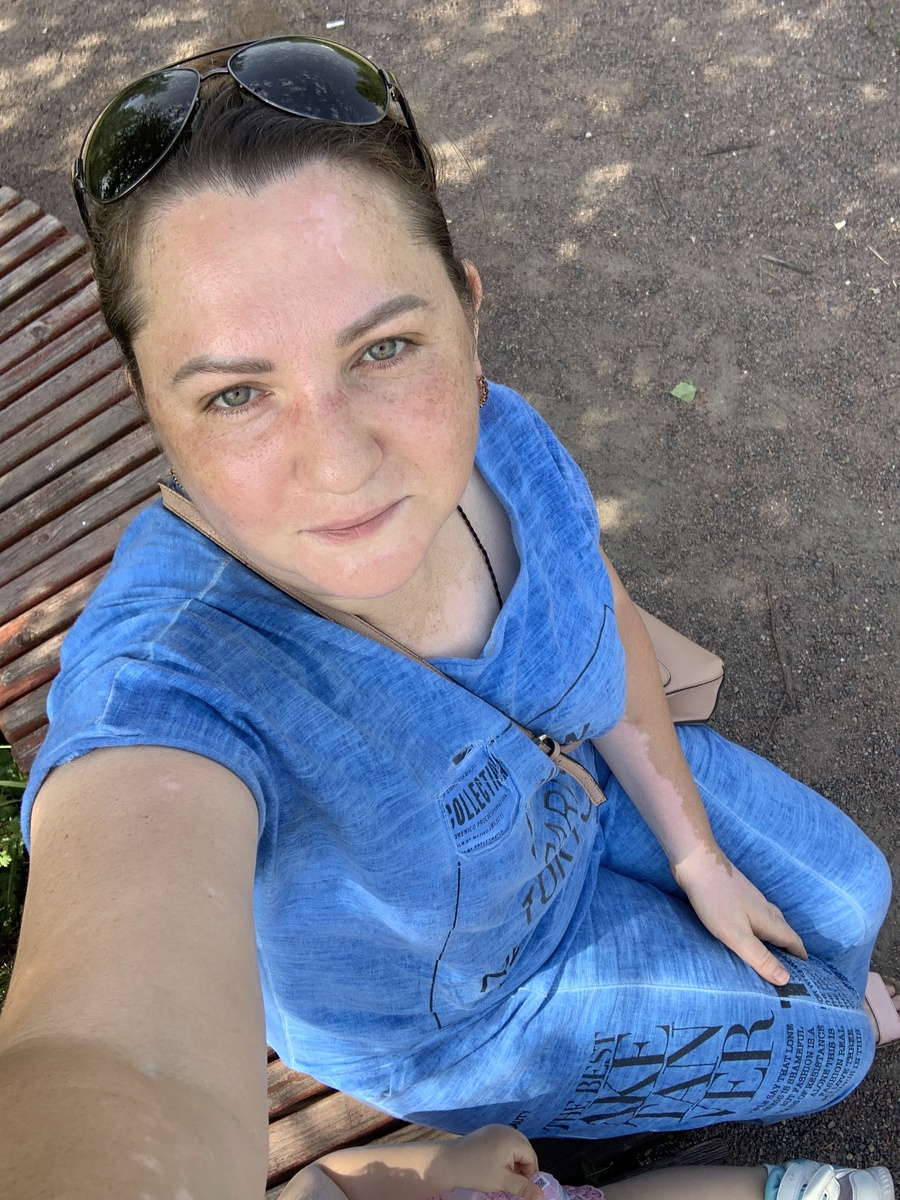 Витилиго прогрессирует, компаньон помогает с фото). Фото автора канала.