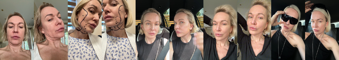 Как я с 10 раза и с подозрением на онкологию решилась на пластику в 45 лет! Часть 2. Подозрение на онкологию и операции быть