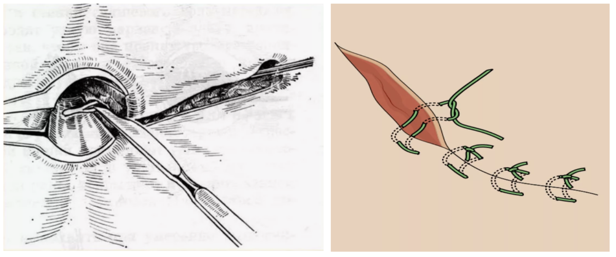 Рисунок 1. Лигатурный свищ – воспаление и нагноение в области наложенного хирургического шва или лигатуры (изображение из интернета).