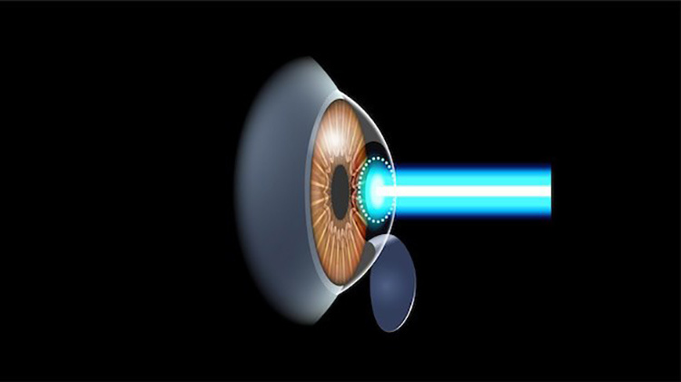 Контактные линзы 