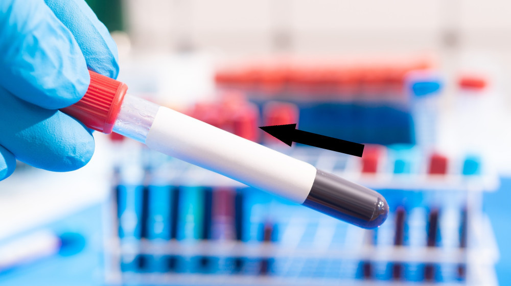    Уникальный анализ крови предполагает обнаружение рака за три года до симптомов