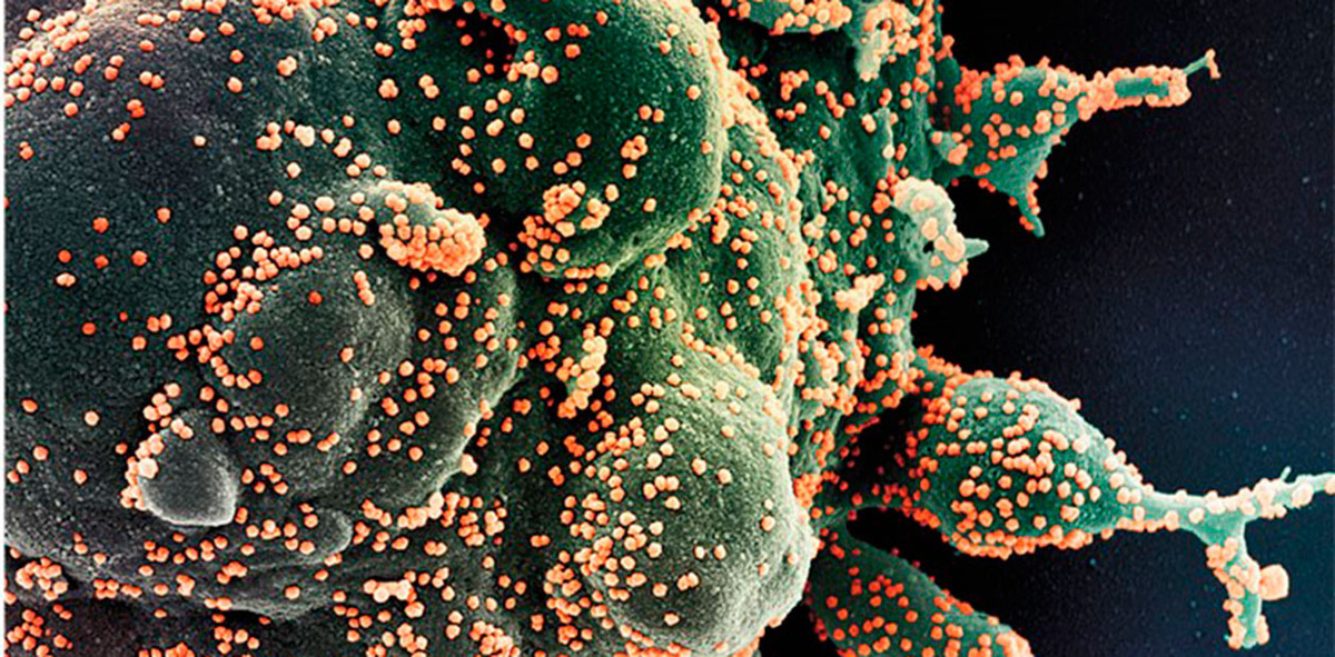 Клетка человека, инфицированная вирионами SARS-CoV-2 (оранжевого цвета), погибает в результате апоптоза. Сканирующая микроскопия. © CC BY 2.0/NIAID