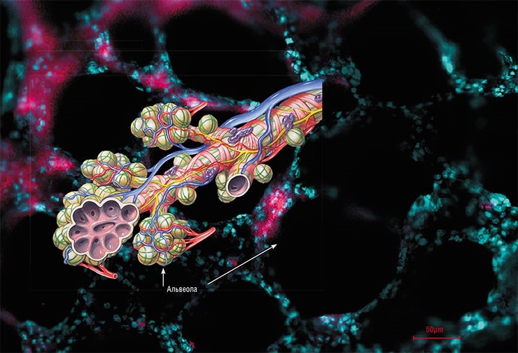 Бронхиальное дерево, по которому в легкие поступает воздух, заканчивается бронхиолами. В их просвет открываются пузырьки-альвеолы, расположенные в легочной ткани, где они густо оплетены капиллярами. При введении в ткань легкого крысы флуоресцентно-меченых наночастиц хитозана, светящихся красным цветом в ультрафиолетовых лучах, свечение проявляется на межальвеолярных перегородках. При коронавирусной пневмонии повреждения в легочной ткани распределены преимущественно аналогичным образом, что свидетельствует о передаче патогена через кровь, а не со слизистым секретом по бронхиальному дереву. Фото из архивов авторов. Бронхиальное дерево – © CC BY 2.5/ Patrick J. Lynch