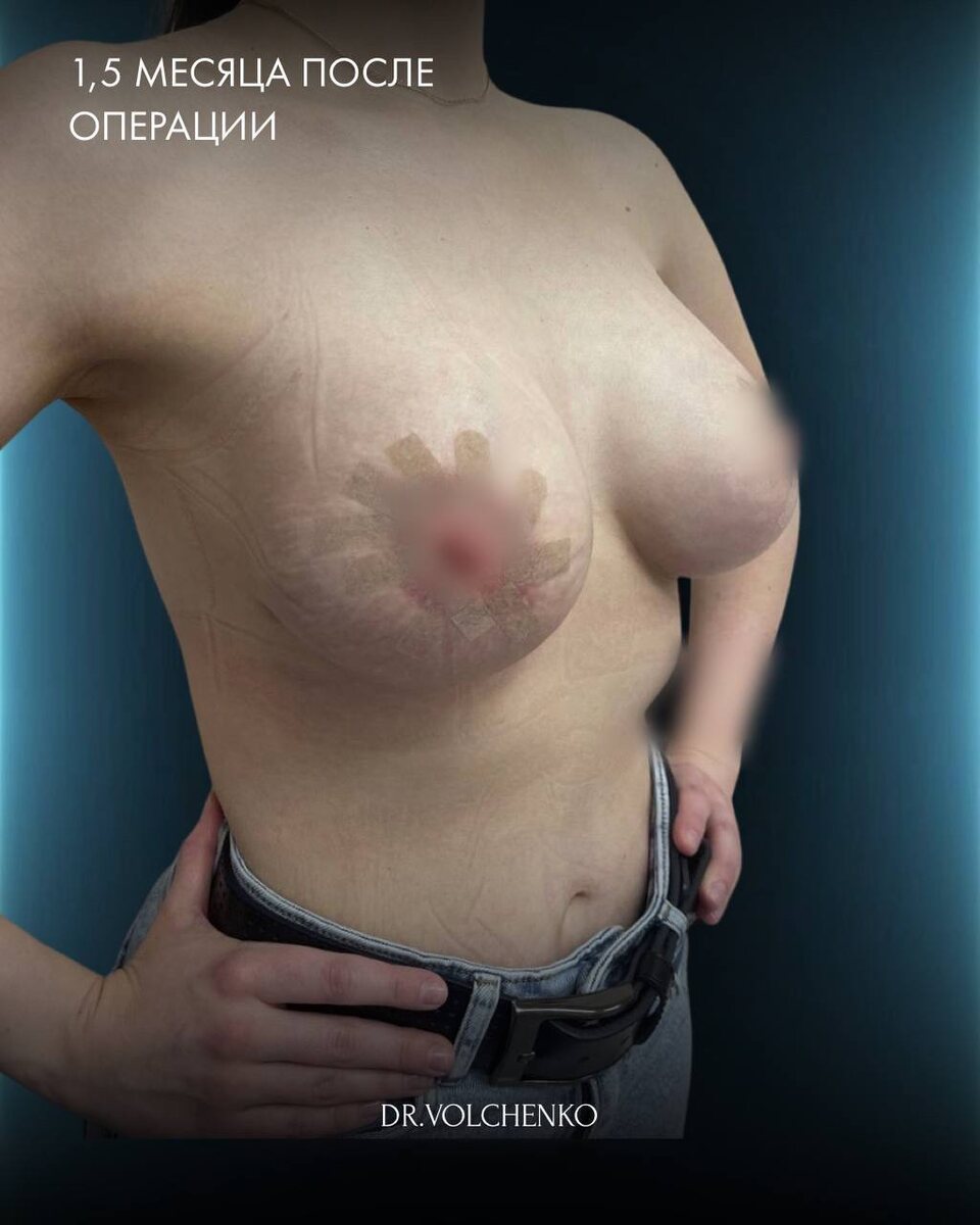 Реконструкция с использованием имплантов