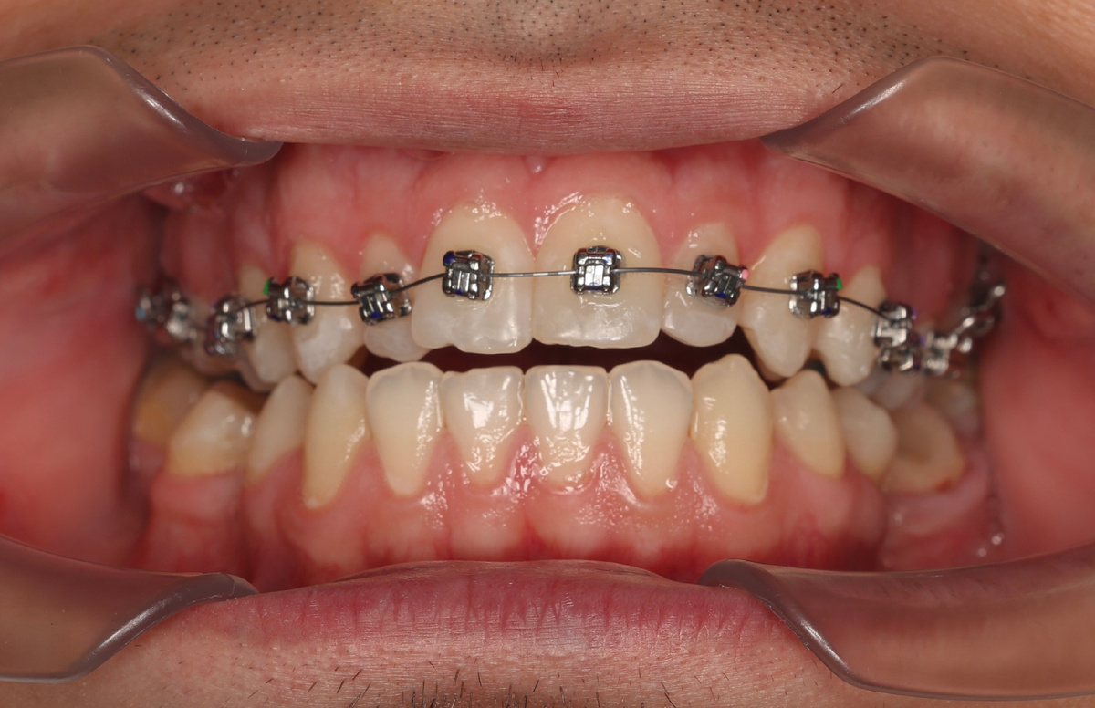 Из-за накладок рот не закрывается