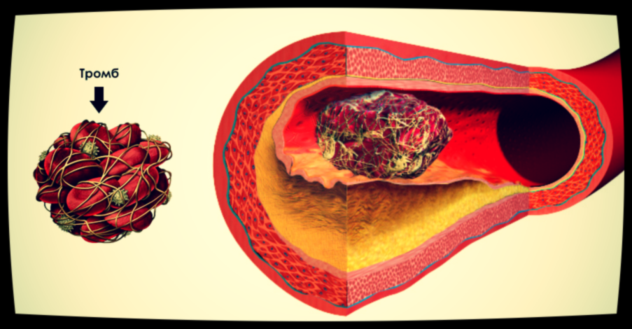 В зоне риска всегда гипертоники, люди с повышенным холестерином. 