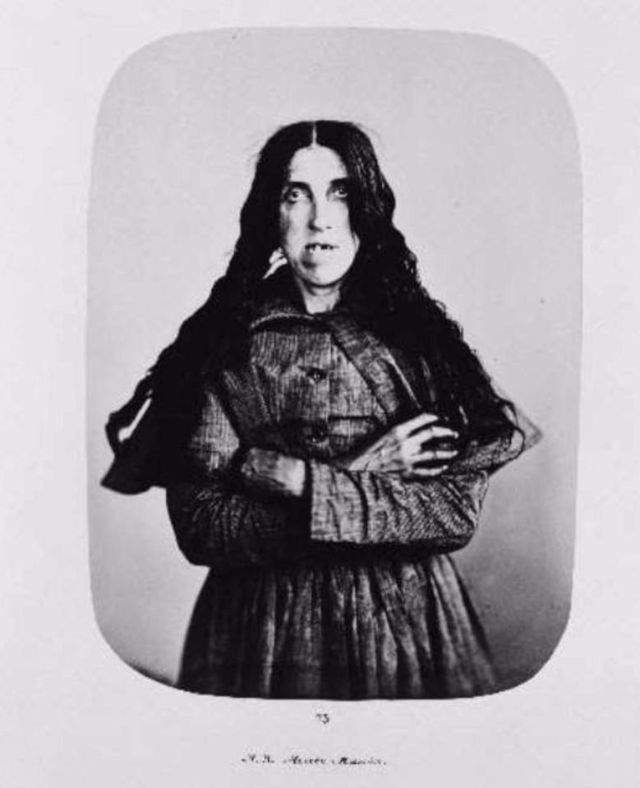 Неизвестная пациентка была госпитализирована в середине XIX века после того, как у нее диагностировали острую манию.