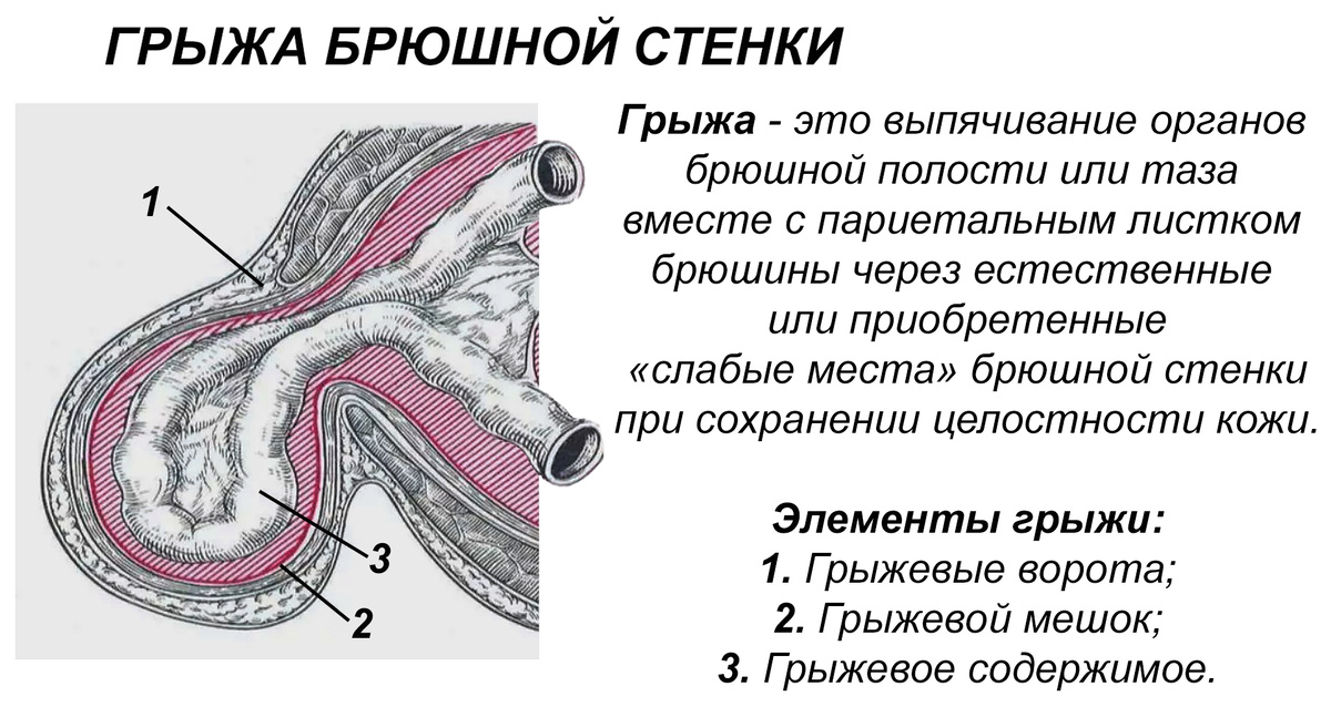 Рисунок 1. Грыжа брюшной стенки. Изображения взяты из интернета и доработаны Перепечаевым К.А.