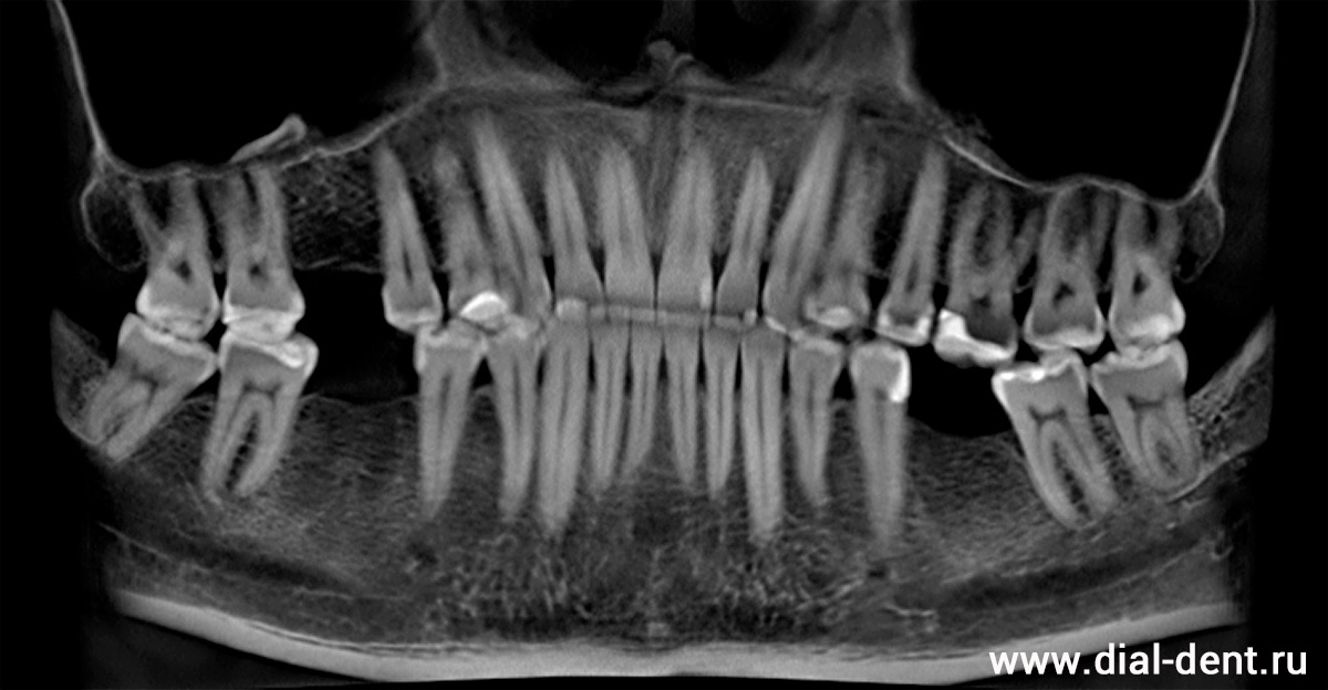 панорамный снимок зубов до лечения - три зуба отсутствуют