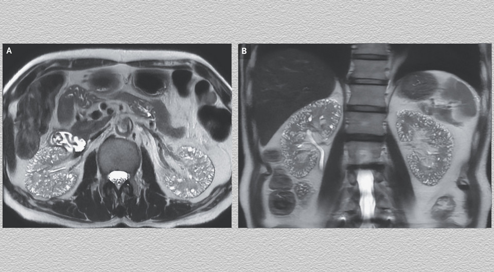   Cheng-Hung Liao, Kao-Lang Liu / NEJM, 2025