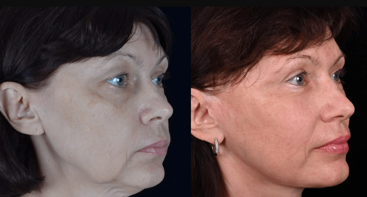 Пластика лица Macs-lift фото до и после. Фото с сайта хирурга Д.Р. Гришкяна. Имеются противопоказания, требуется консультация специалиста